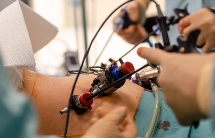 Operacja laparoskopowa